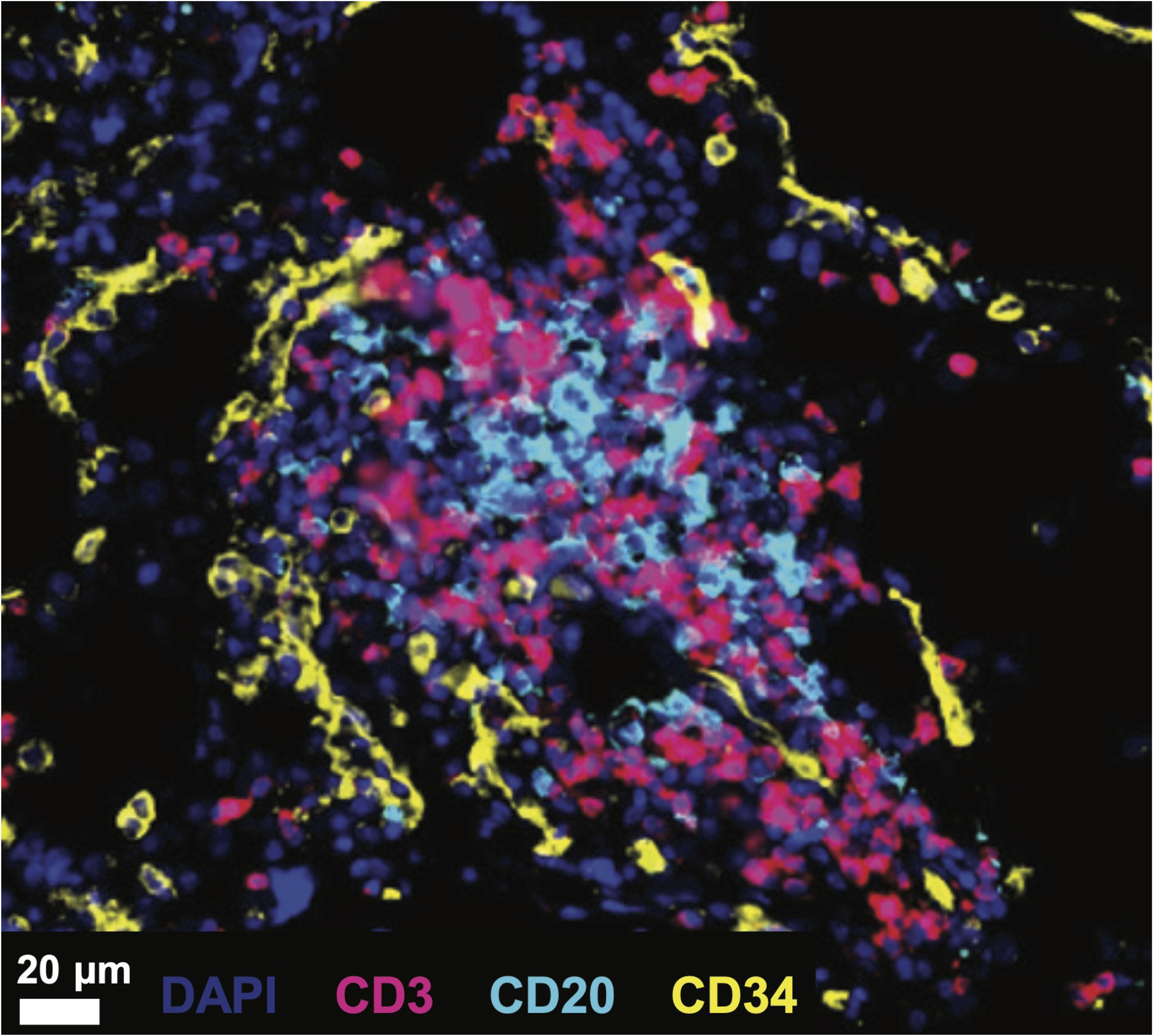 A multidimensional analysis reveals distinct immune phenotypes and the composition of immune aggregates in pediatric acute myeloid leukemia